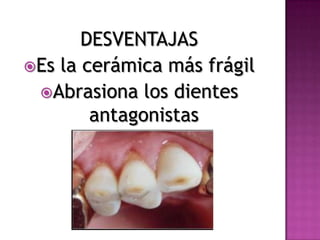 DESVENTAJASEs la cerámica más frágilAbrasiona los dientes antagonistas