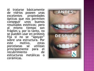 Al tratarse básicamente de vidrios poseen unas excelentes propiedades ópticas que nos permiten conseguir unos buenos resultados estéticos; pero al mismo tiempo son frágiles y, por lo tanto, no se pueden usar en prótesis fija si no se “apoyan” sobre una estructura. Por este motivo, estas porcelanas se utilizan principalmente para el recubrimiento de estructuras metálicas o cerámicas.