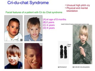 Cri-du-chat Syndrome
(A) at age of 8 months
(B) 2 years
(C) 4 years
(D) 9 years
Facial features of a patient with Cri du Chat syndrome
• Unusual high pitch cry
• Physical and mental
retardation
 