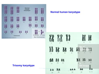 Normal human karyotype
Trisomy karyotype
 