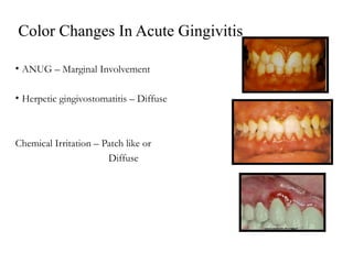 6 clinical features of gingivitis 1.ppt gingival inflammation gingival ...