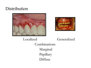6 clinical features of gingivitis 1.ppt gingival inflammation gingival ...