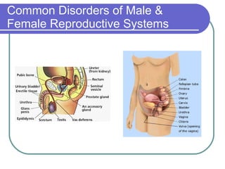 Common Disorders of Male & Female Reproductive Systems 