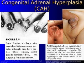 Congenital Adrenal Hyperplasia (CAH)   Luria, Z., Friedman, S., and Rose, M.D.  HUMAN SEXUALITY.  New York:  John Wiley & Sons (1987) Forbes, C.D. and Jackson, W.F.  A COLOUR ATLAS AND TEXT OF CLINICAL MEDICINE.  England:  Mosby-Wolfe (1993) 