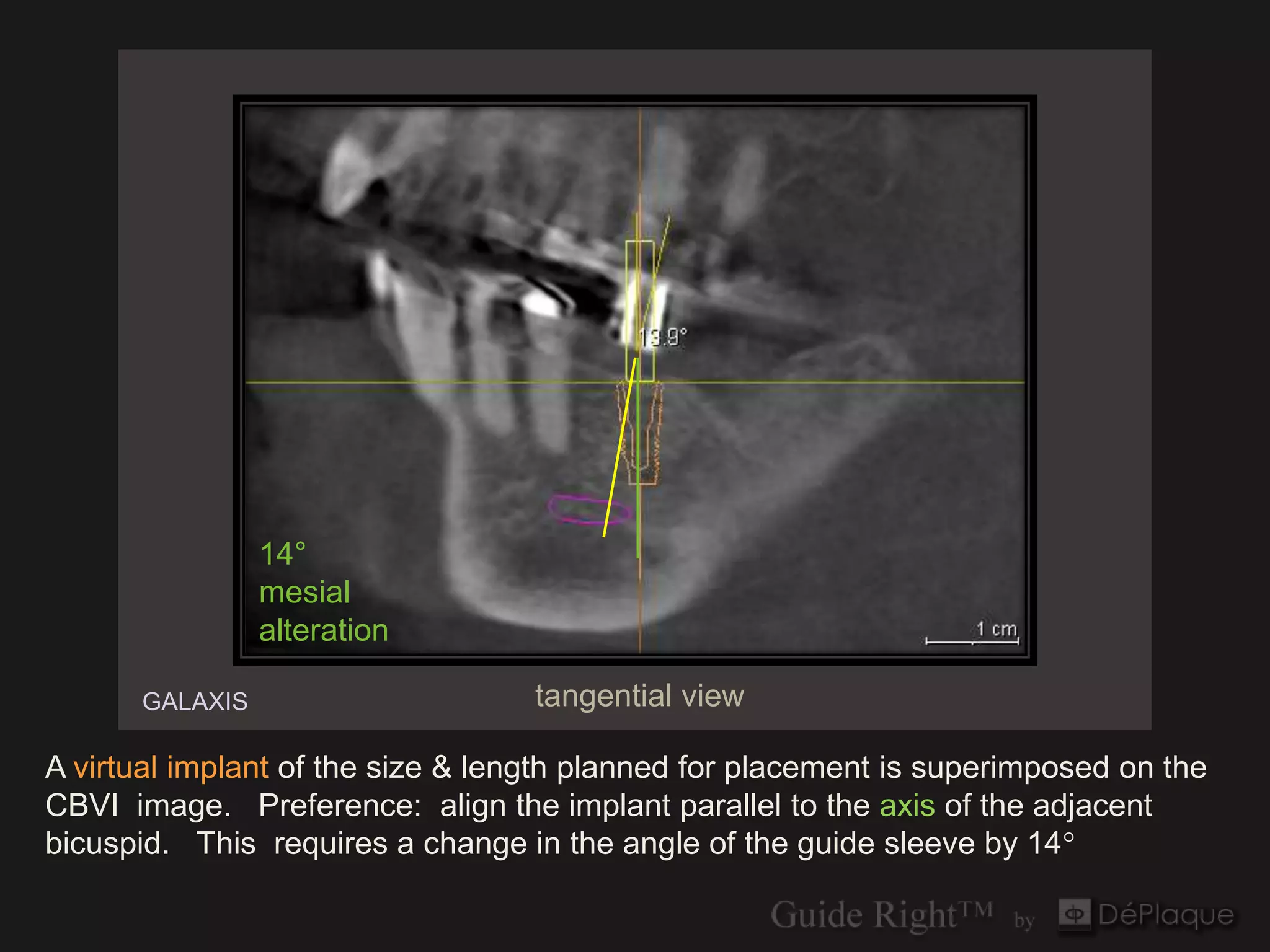 14°
                mesial
                alteration

      GALAXIS                     tangential view

A virtual implant of the size & length planned for placement is superimposed on the
CBVI image. Preference: align the implant parallel to the axis of the adjacent
bicuspid. This requires a change in the angle of the guide sleeve by 14°
 