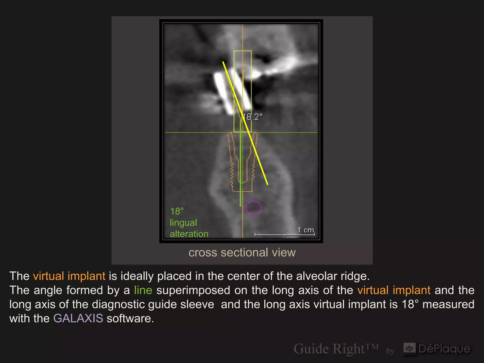 18°
                               lingual
                               alteration

                                   cross sectional view
The virtual implant is ideally placed in the center of the alveolar ridge.
The angle formed by a line superimposed on the long axis of the virtual implant and the
long axis of the diagnostic guide sleeve and the long axis virtual implant is 18° measured
with the GALAXIS software.
 