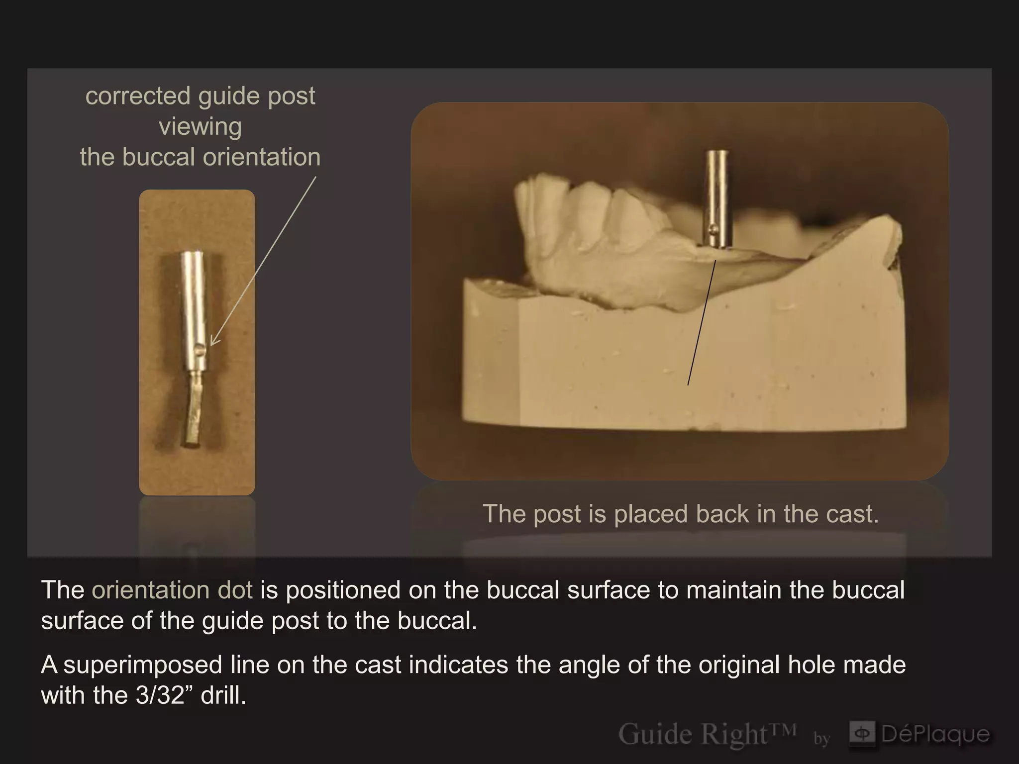 corrected guide post
          viewing
   the buccal orientation




                                       The post is placed back in the cast.

The orientation dot is positioned on the buccal surface to maintain the buccal
surface of the guide post to the buccal.
A superimposed line on the cast indicates the angle of the original hole made
with the 3/32” drill.
 