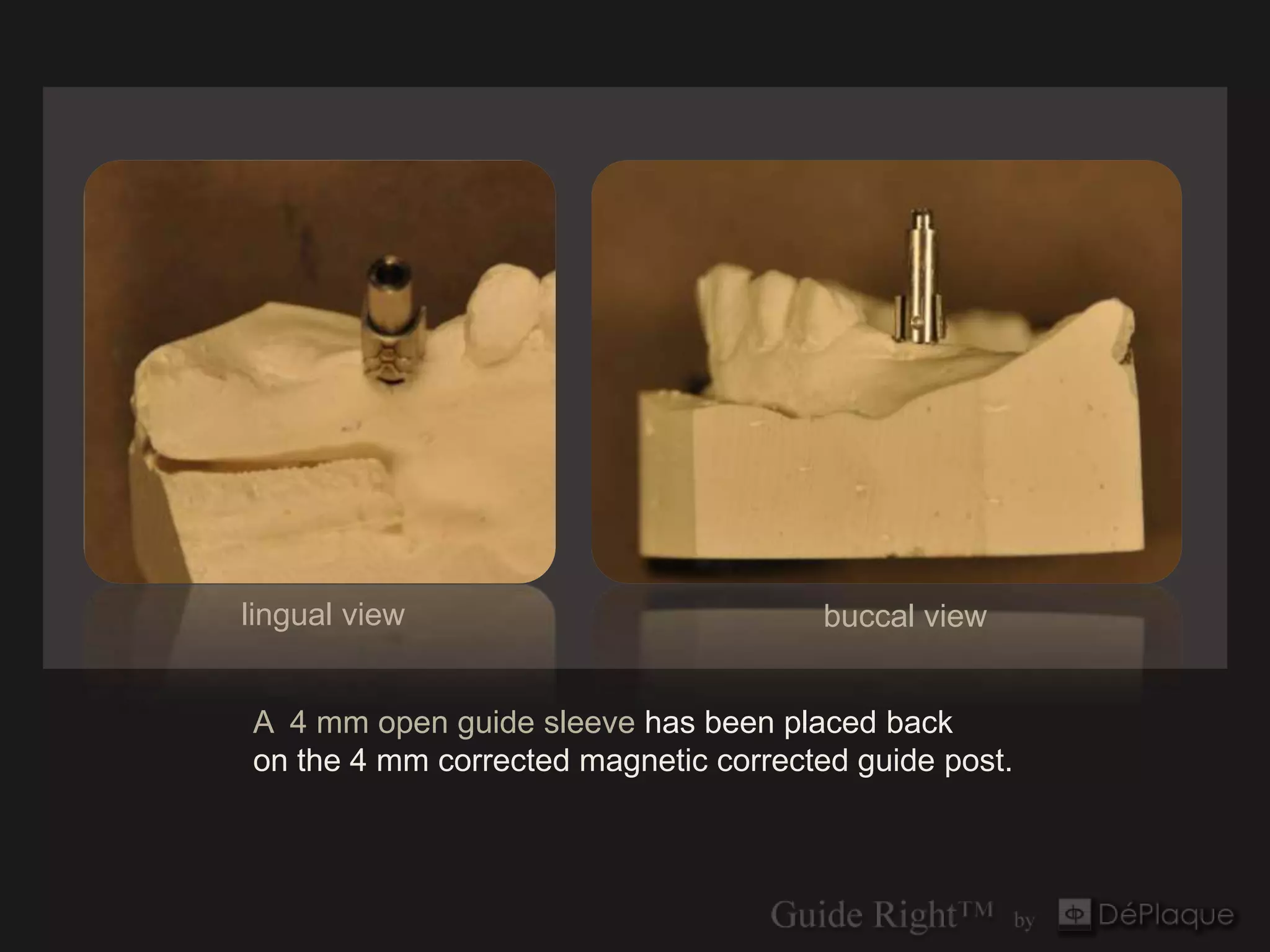 lingual view                           buccal view


A 4 mm open guide sleeve has been placed back
on the 4 mm corrected magnetic corrected guide post.
 