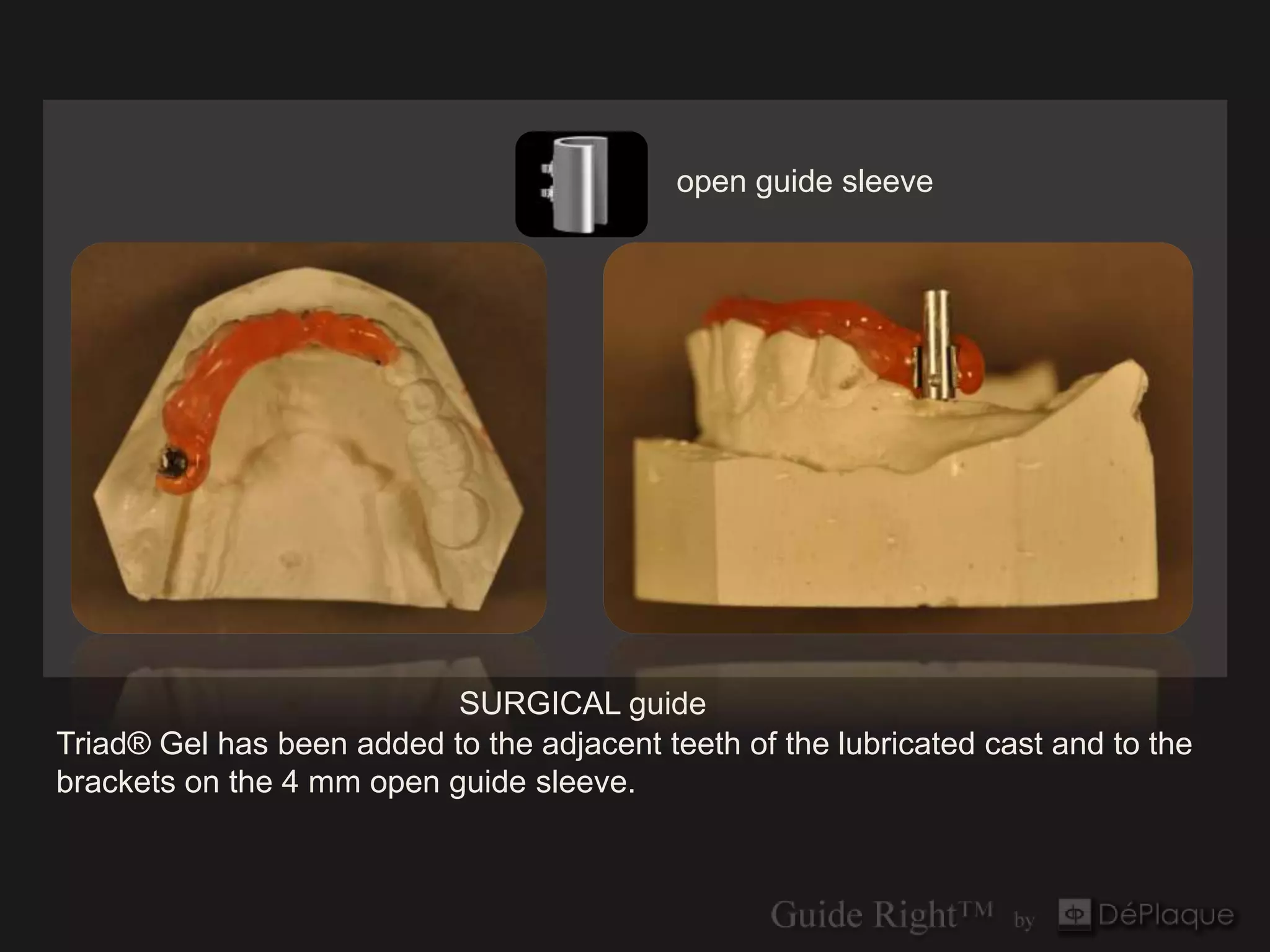open guide sleeve




                           SURGICAL guide
Triad® Gel has been added to the adjacent teeth of the lubricated cast and to the
brackets on the 4 mm open guide sleeve.
 