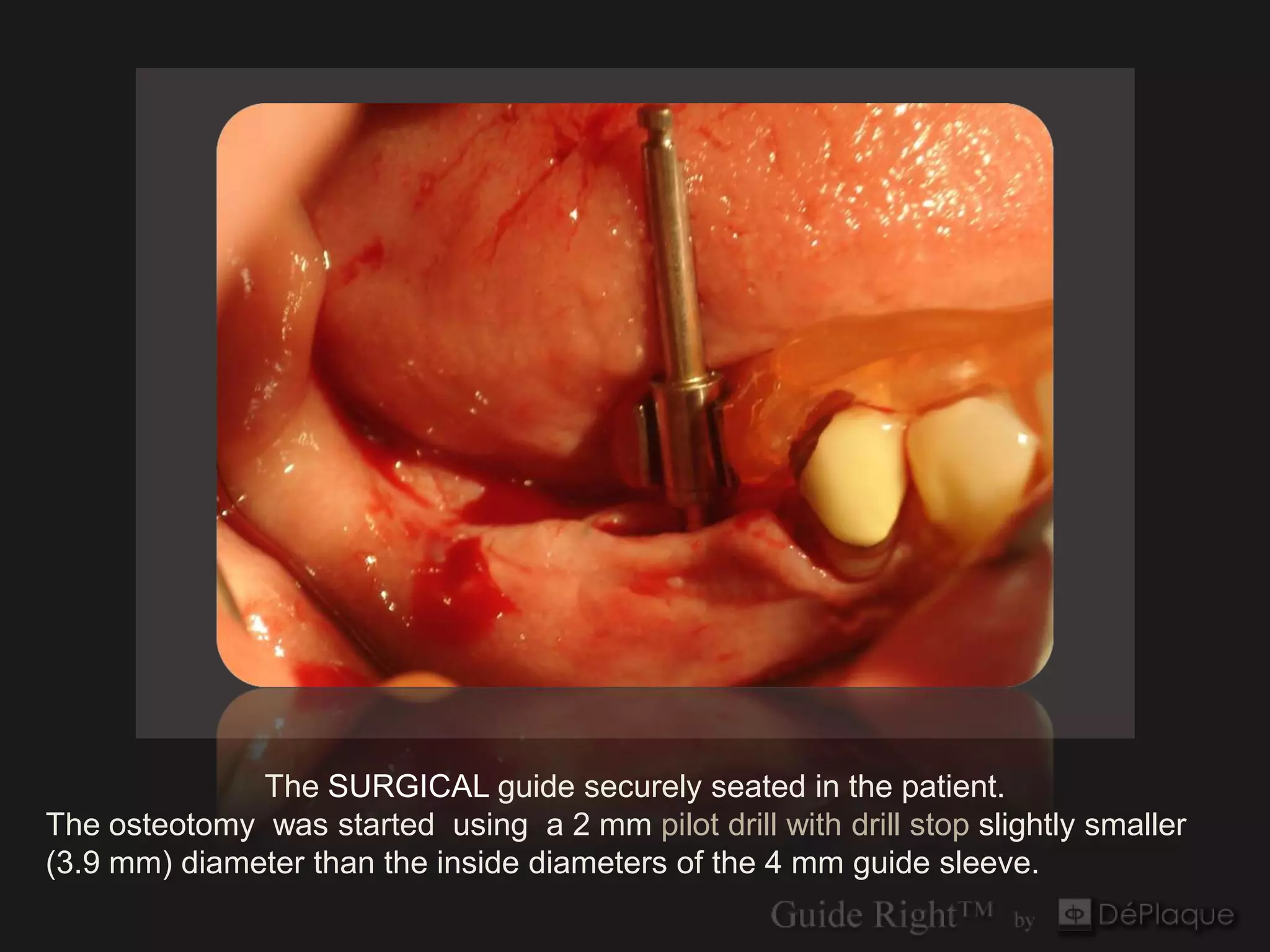 The SURGICAL guide securely seated in the patient.
The osteotomy was started using a 2 mm pilot drill with drill stop slightly smaller
(3.9 mm) diameter than the inside diameters of the 4 mm guide sleeve.
 