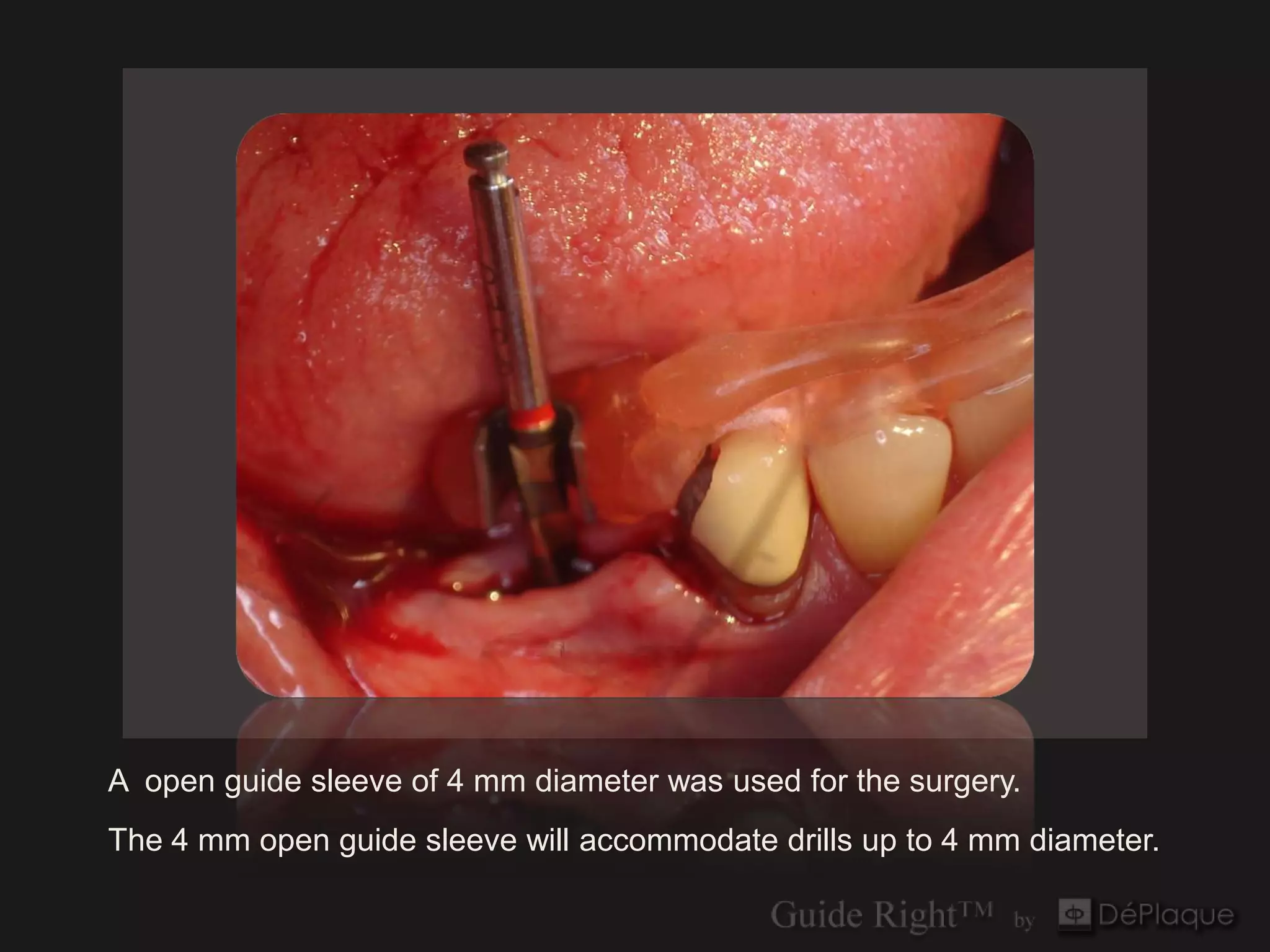 A open guide sleeve of 4 mm diameter was used for the surgery.
The 4 mm open guide sleeve will accommodate drills up to 4 mm diameter.
 