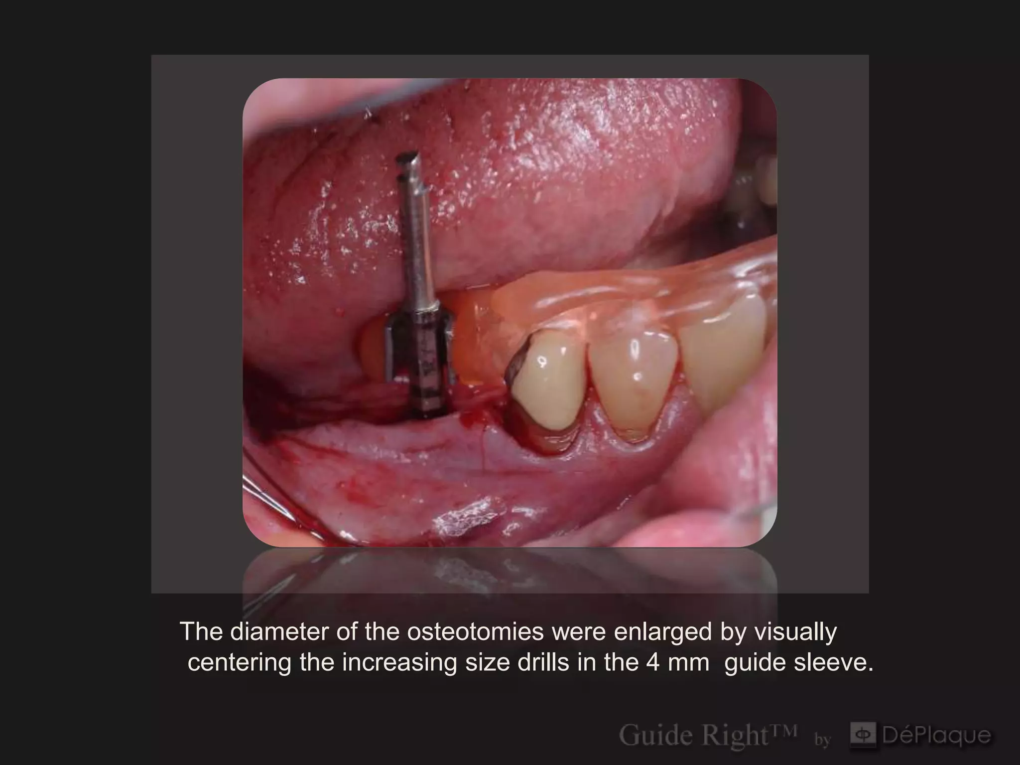 The diameter of the osteotomies were enlarged by visually
 centering the increasing size drills in the 4 mm guide sleeve.
 
