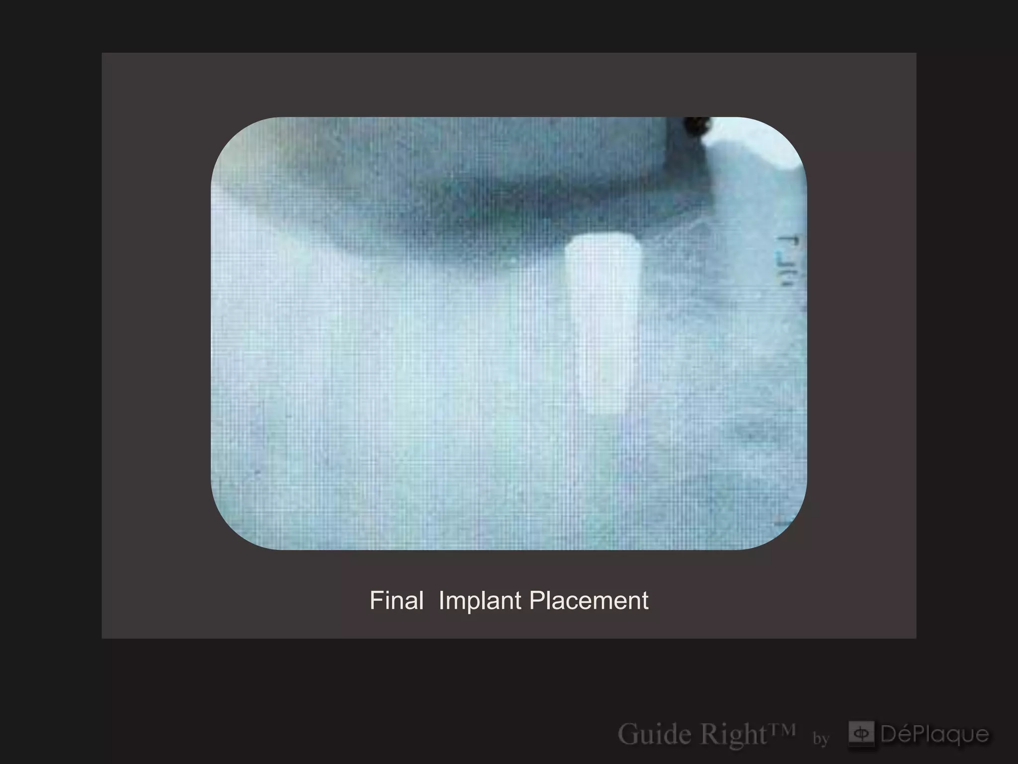Final Implant Placement
 