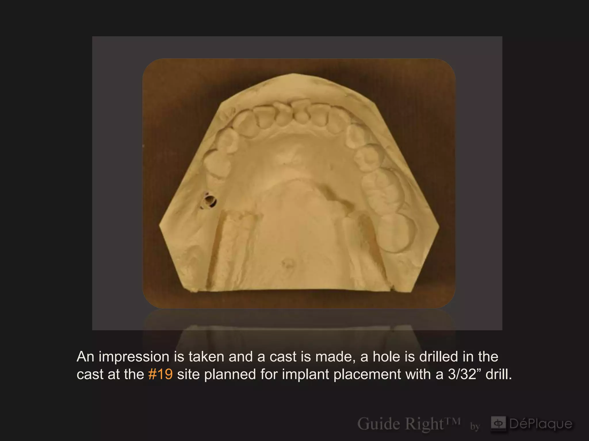 An impression is taken and a cast is made, a hole is drilled in the
cast at the #19 site planned for implant placement with a 3/32” drill.
 
