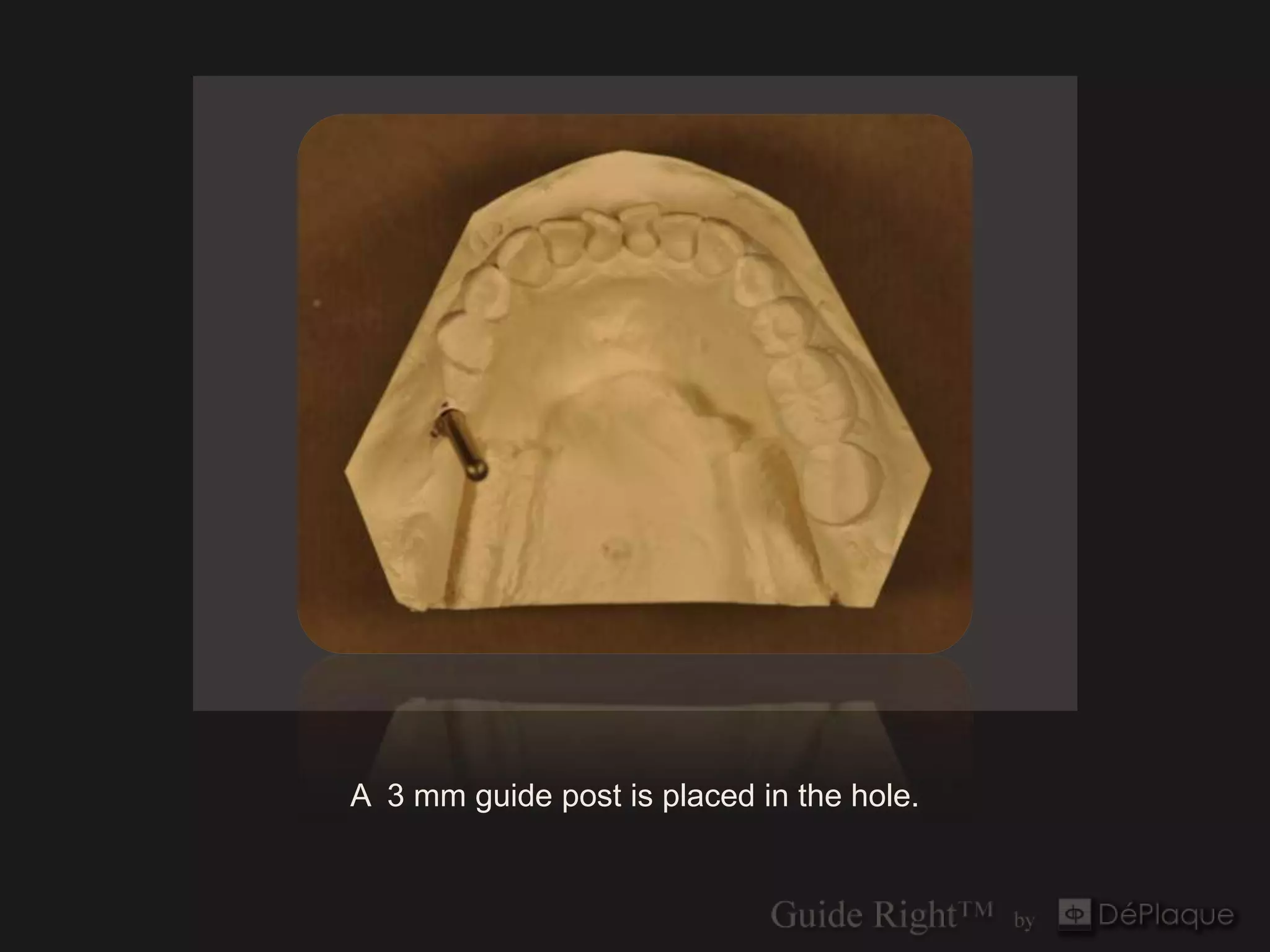 A 3 mm guide post is placed in the hole.
 