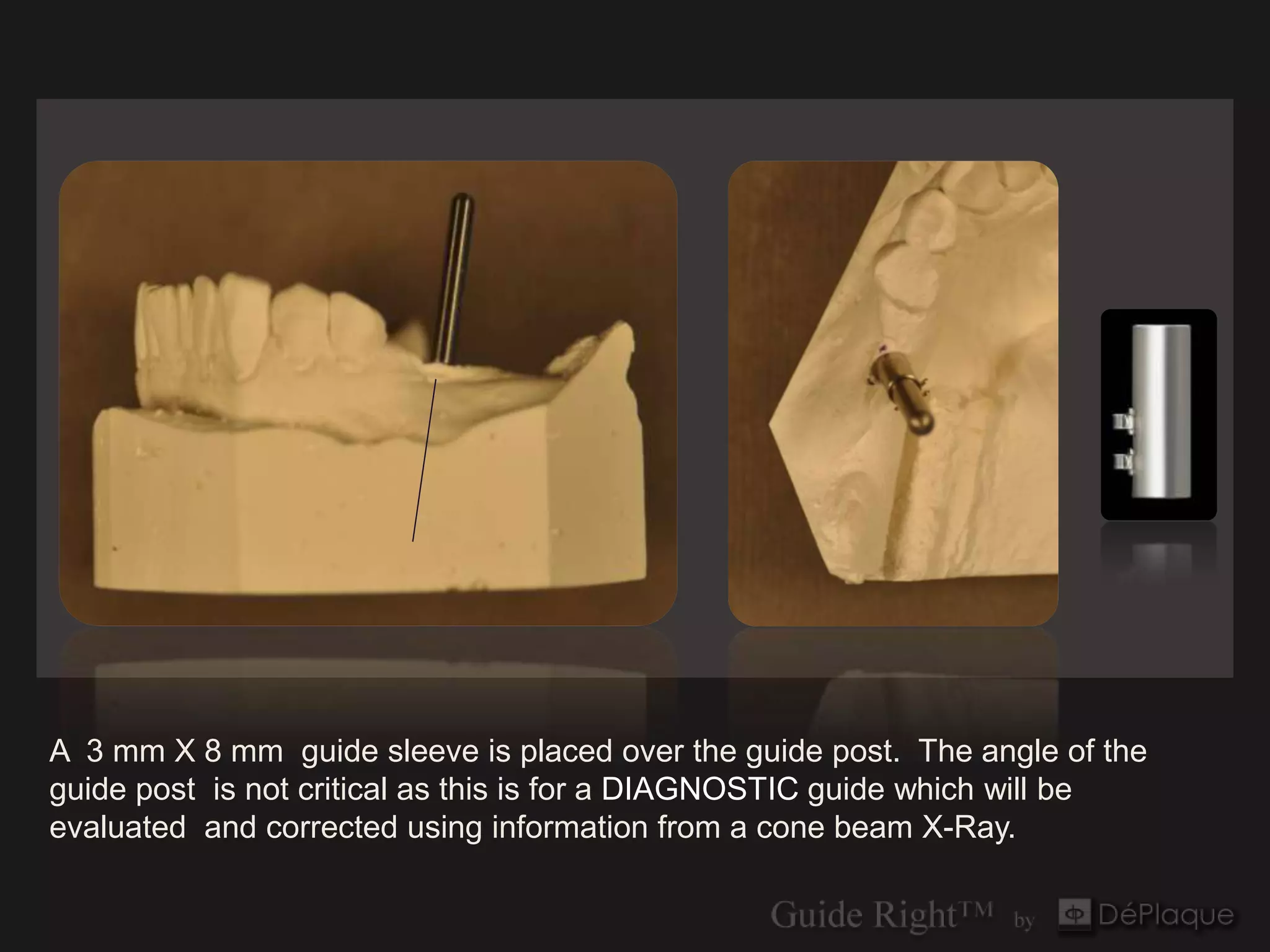 A 3 mm X 8 mm guide sleeve is placed over the guide post. The angle of the
guide post is not critical as this is for a DIAGNOSTIC guide which will be
evaluated and corrected using information from a cone beam X-Ray.
 
