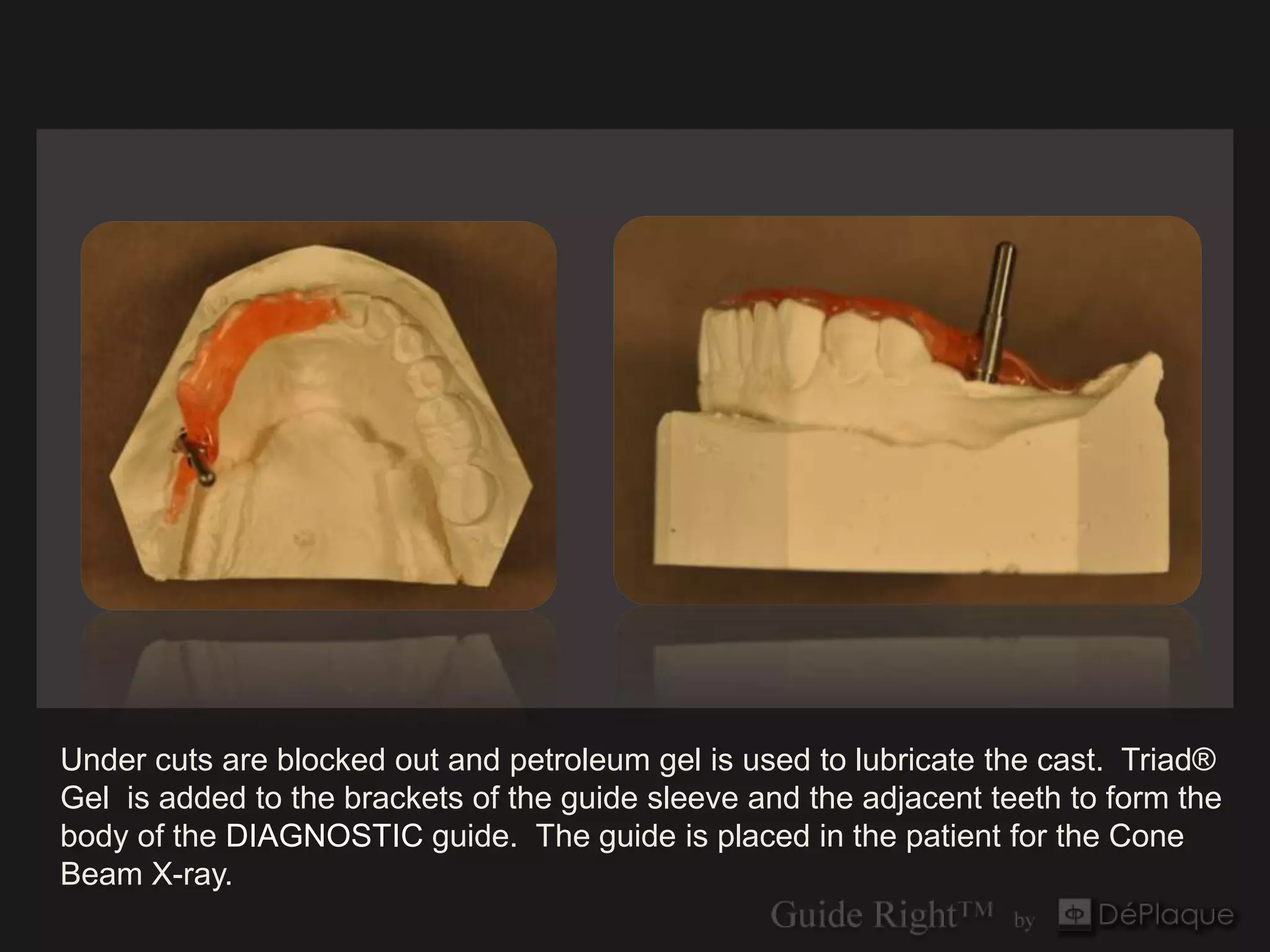 Under cuts are blocked out and petroleum gel is used to lubricate the cast. Triad®
Gel is added to the brackets of the guide sleeve and the adjacent teeth to form the
body of the DIAGNOSTIC guide. The guide is placed in the patient for the Cone
Beam X-ray.
 