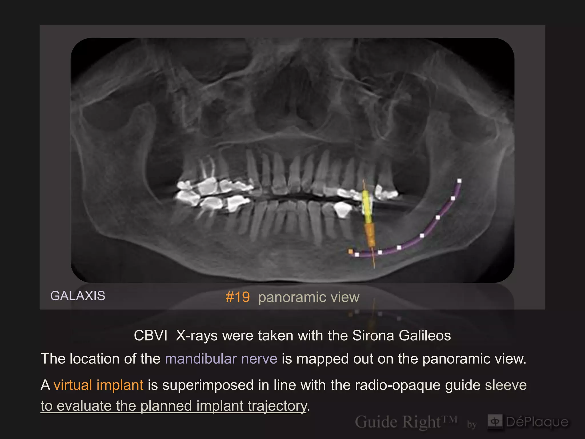 GALAXIS                    #19 panoramic view

              CBVI X-rays were taken with the Sirona Galileos
The location of the mandibular nerve is mapped out on the panoramic view.
A virtual implant is superimposed in line with the radio-opaque guide sleeve
to evaluate the planned implant trajectory.
 