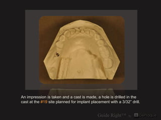 An impression is taken and a cast is made, a hole is drilled in the
cast at the #19 site planned for implant placement wit...