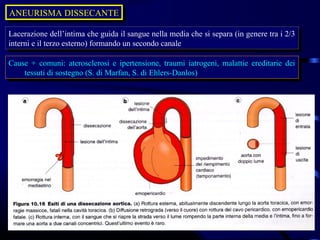 ANEURISMA DISSECANTE
ANEURISMA DISSECANTE

Lacerazione dell’intima che guida il sangue nella media che si separa (in genere tra i i2/3
 Lacerazione dell’intima che guida il sangue nella media che si separa (in genere tra 2/3
interni eeil terzo esterno) formando un secondo canale
 interni il terzo esterno) formando un secondo canale

Cause + comuni: aterosclerosi ee ipertensione, traumi iatrogeni, malattie ereditarie dei
 Cause + comuni: aterosclerosi ipertensione, traumi iatrogeni, malattie ereditarie dei
    tessuti di sostegno (S. di Marfan, S. di Ehlers-Danlos)
     tessuti di sostegno (S. di Marfan, S. di Ehlers-Danlos)
 