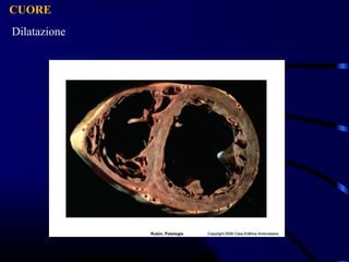 CUORE
Dilatazione
 