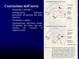 Coartazione dell’aorta
  –   Preduttale o infantile =
      restringimento           dell’aorta
      prossimale all’apertura del dotto
      arterioso
  –   Postduttale o adulto =
      restringimento dell’aorta distale
      all’apertura del dotto; tipo piu’
      comune      che      consente    la
      sopravvivenza
 