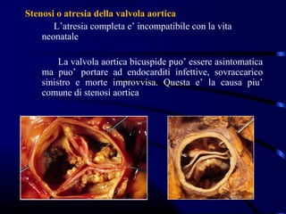 Stenosi o atresia della valvola aortica
       L’atresia completa e’ incompatibile con la vita
    neonatale

         La valvola aortica bicuspide puo’ essere asintomatica
    ma puo’ portare ad endocarditi infettive, sovraccarico
    sinistro e morte improvvisa. Questa e’ la causa piu’
    comune di stenosi aortica
 