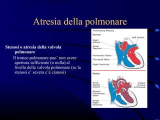 Atresia della polmonare

Stenosi o atresia della valvola
     polmonare
    Il tronco polmonare puo’ non avere
     apertura sufficiente (o nulla) al
     livello della valvola polmonare (se la
     stenosi e’ severa c’è cianosi)
 