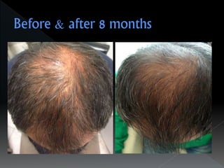 Alopecia-Drampa Christina