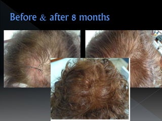 Alopecia-Drampa Christina