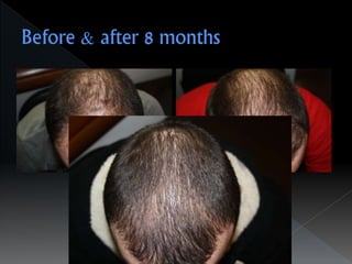 Alopecia-Drampa Christina