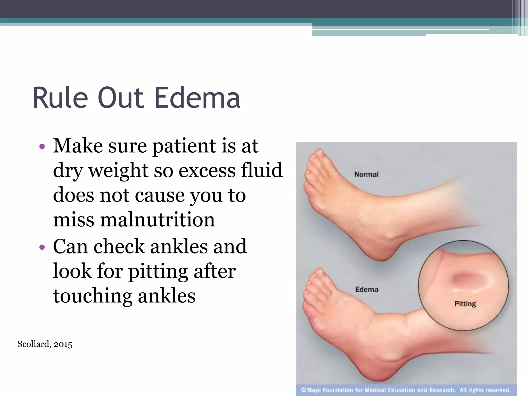 Rule Out Edema
• Make sure patient is at
dry weight so excess fluid
does not cause you to
miss malnutrition
• Can check ankles and
look for pitting after
touching ankles
Scollard, 2015
 