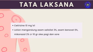 Cetirizine 10 mg 1x1
Lotion mengandung asam salisilat 3%, asam benzoat 6%,
mikonazol 2% cr 10 gr oles pagi dan sore
 