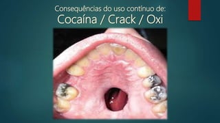 perfuração de septo
Consequências do uso contínuo de:
Cocaína / Crack / Oxi
 