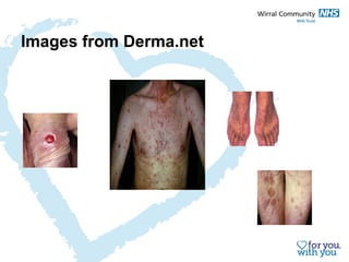 Images from Derma.net 
 