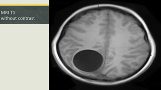 MRI T1
without contrast
 