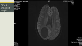 Diffusion
Weighted
Image
 