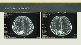 Post OP MRI with CM T2
 