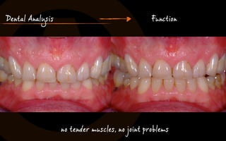 Dental Analysis Function 
no tender muscles, no joint problems 
 