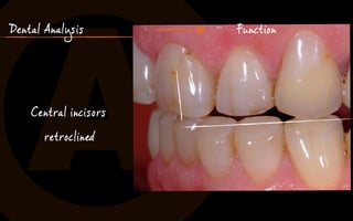 Dental Analysis Function 
Central incisors 
retroclined 
 