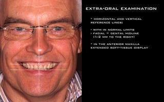extra-oral examination 
* horizontal and vertical 
reference lines: 
! 
- with in normal limits 
- facial = dental midline 
(1/2 mm to the right) 
! 
* in the anterior maxilla 
extended soft-tissue display 
 