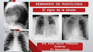 SEMINARIO DE RADIOLOGIA
Dra. Edda Leonor Velásquez
Gutiérrez
R1 Neumología
El signo de la silueta
 