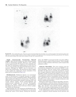 76  Nuclear Medicine: The Requisites
Single Autonomously Functioning Thyroid
­Nodule.  Most thyroid nodules are either nonfunctioning
(cold) or functioning normally. However, toxic nodules
occur in approximately 5% of patients with a palpable nod-
ule. Once an autonomous nodule grows to a size of 2.5 to
3.0 cm, it may produce the clinical manifestations of thyro-
toxicosis. Although the %RAIU may be elevated, it is
often in the normal range. The thyroid scan shows uptake
in the nodule but suppression of the remainder of the
gland and low background (Fig. 6-13).
Hashitoxicosis.  Hashimoto disease is an uncommon
cause of thyrotoxicosis. It typically presents in middle-
aged women as goiter and hypothyroidism. Histopathologi-
cally, lymphocytic infiltration is characteristic. The gland is
diffusely and symmetrically enlarged, nontender, firm, and
usually without nodules. Serum antithyroglobulin and
antimicrosomal antibodies are elevated. Scintigraphic
findings are variable. Uptake may be inhomogeneous
throughout the gland, or focal cold areas without a palpa-
ble nodule may be present.
Approximately 3% to 5% of patients with Hashimoto dis-
ease develop thyrotoxicosis, or hashitoxicosis, at some point
during the course of the disease. During the thyrotoxic
phase, the %RAIU is increased and the scan shows diffuse
increased uptake, similar to Graves disease. This is thought
to be an overlap syndrome with Graves and is treated with
radioactive iodine.
Subacute Thyroiditis.  The most common cause for
thyrotoxicosis associated with a decreased %RAIU is sub-
acute thyroiditis. This has various causes. Granulomatous
thyroiditis (de Quervain) is typically preceded by several
days of upper respiratory illness and tender thyroid. Silent
thyroiditis, usually occurring in the elderly, is not associated
with respiratory symptoms or thyroid tenderness and is not
a granulomatous process, but probably viral. Patients often
have arrhythmia and a normal-sized thyroid. Postpartum
thyroiditis occurs within weeks or months of delivery, with
positive antithyroid antibodies.
During the initial stage of subacute thyroiditis, thyrotoxi-
cosis predominates, caused by release of thyroid hormone as
a result of inflammation and increased membrane permea-
bility. The elevated serum thyroid hormone suppresses
TSH. This is the stage at which patients are usually referred
for a scan and uptake to differentiate it from Graves disease.
As the inflammation resolves and the thyroid gland hor-
mone is depleted, thyroid hormone levels decrease and
RT
SSN
LAO RAO
ANT
Figure 6-11.  Toxic multinodular goiter. Thyrotoxic patient who had multiple thyroid nodules seen on ultrasonography. The thyroid scan shows mul-
tiple areas of increased uptake consistent with hot nodules in both lobes and suppression of the remaining normal functioning thyroid. ANT, Anterior;
LAO, left anterior oblique; RAO, right anterior oblique; RT, right; SSN, suprasternal notch.
 