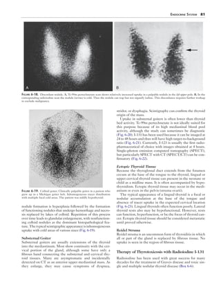 Endocrine System  81
nodule formation is hyperplasia followed by the formation
of functioning nodules that undergo hemorrhage and necro-
sis replaced by lakes of colloid. Repetition of this process
over time leads to glandular enlargement, with nonfunction-
ing colloid nodules as the dominant histopathological fea-
ture.Thetypicalscintigraphicappearanceisinhomogeneous
uptake with cold areas of various sizes (Fig. 6-19).
Substernal Goiter
Substernal goiters are usually extensions of the thyroid
into the mediastinum. Most show continuity with the cer-
vical portion of the gland, although some have only a
fibrous band connecting the substernal and cervical thy-
roid tissues. Many are asymptomatic and incidentally
detected on CT as an anterior upper mediastinal mass. As
they enlarge, they may cause symptoms of dyspnea,
stridor, or dysphagia. Scintigraphy can confirm the thyroid
origin of the mass.
Uptake in substernal goiters is often lower than thyroid
bed activity. Tc-99m pertechnetate is not ideally suited for
this purpose because of its high mediastinal blood pool
activity, although the study can sometimes be diagnostic
(Fig. 6-20). I-131 has been used because it can be imaged at
24 to 48 hours and thus will have high target-to-background
ratio (Fig. 6-21). Currently, I-123 is usually the first radio-
pharmaceutical of choice with images obtained at 4 hours.
Single-photon emission computed tomography (SPECT),
but particularly SPECT with CT (SPECT/CT) can be con-
firmatory (Fig. 6-22).
Ectopic Thyroid Tissue
Because the thyroglossal duct extends from the foramen
cecum at the base of the tongue to the thyroid, lingual or
upper cervical thyroid tissue can present in the neonate or
child as a midline mass. It is often accompanied by hypo-
thyroidism. Ectopic thyroid tissue may occur in the medi-
astium or even in the pelvis (struma ovarii).
The typical appearance of a lingual thyroid is a focal or
nodular accumulation at the base of the tongue and
absence of tracer uptake in the expected cervical location
(Fig. 6-23). Lingual thyroids often function poorly. Lateral
thyroid rests also may be hypofunctional. However, rests
can function, hyperfunction, or be the focus of thyroid can-
cer. Ectopic thyroid tissue should be considered metastatic
until proved otherwise.
Reidel Struma
Reidel struma is an uncommon form of thyroiditis in which
all or part of the gland is replaced by fibrous tissue. No
uptake is seen in the region of fibrous tissue.
Therapy of Thyrotoxicosis with Radioiodine I-131
Radioiodine has been used with great success for many
decades for the treatment of Graves disease and toxic sin-
gle and multiple nodular thyroid disease (Box 6-6).
BA
Figure 6-18.  Discordant nodule. A, Tc-99m pertechnetate scan shows relatively increased uptake in a palpable nodule in the left upper pole. B, In the
corresponding radioiodine scan the nodule (arrow) is cold. Thus the nodule can trap but not organify iodine. This discordance requires further workup
to exclude malignancy.
Figure 6-19.  Colloid goiter. Clinically palpable goiter in a patient who
grew up in a Michigan goiter belt. Inhomogeneous tracer distribution
with multiple focal cold areas. The patient was mildly hypothyroid.
 