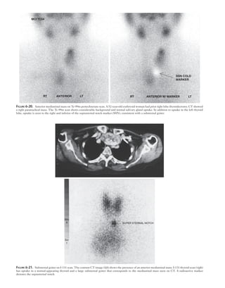 MCI TC04
RT ANTERIOR LT RT ANTERIOR W/ MARKER LT
SSN COLD
MARKER
Figure 6-20.  Anterior mediastinal mass on Tc-99m pertechnetate scan. A 52-year-old euthryoid woman had prior right lobe thyroidectomy. CT showed
a right paratracheal mass. The Tc-99m scan shows considerable background and normal salivary gland uptake. In addition to uptake in the left thyroid
lobe, uptake is seen to the right and inferior of the suprasternal notch marker (SSN), consistent with a substernal goiter.
SUPER STERNAL NOTCH
Win
A
Scr
1
Figure 6-21.  Substernal goiter on I-131 scan. The contrast CT image (left) shows the presence of an anterior mediastinal mass. I-131 thyroid scan (right)
has uptake in a normal-appearing thyroid and a large substernal goiter that corresponds to the mediastinal mass seen on CT. A radioactive marker
denotes the suprasternal notch.
 