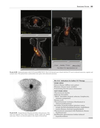 Endocrine System  83
Figure 6-22.  Substernal goiter with I-123 hybrid SPECT/CT. The I-123 thyroid scan is fused with the CT scan in selected transverse, sagittal, and
coronal views. This patient had a multinodular toxic goiter with substernal extension.
Figure 6-23.  Lingual thyroid. Hypothyroid infant with neck mass. Thy-
roid scan (anterior view) shows prominent uptake within the midline
neck mass. There is no thyroid uptake in the region of thyroid bed.
	Box 6-6.  Indications for Iodine-131 Therapy
INDICATED
Graves disease (diffuse toxic goiter)
Plummer disease (toxic nodules)
Functioning thyroid cancer (metastatic)
NOT INDICATED
Thyrotoxicosis factitia
Subacute thyroiditis
“Silent” thyroiditis (atypical, subacute, lymphocytic,
transient, postpartum)
Struma ovarii
Thyroid hormone resistance (biochemical or
clinical manifestations)
Secondary hyperthyroidism (pituitary tumor,
ectopic thyroid-stimulating hormone, trophoblastic
tumors [human chorionic gonadotropin])
Thyrotoxicosis associated with Hashimoto disease
(hashitoxicosis)
Jod-Basedow phenomenon (iodine-induced
hyperthyroidism)
 