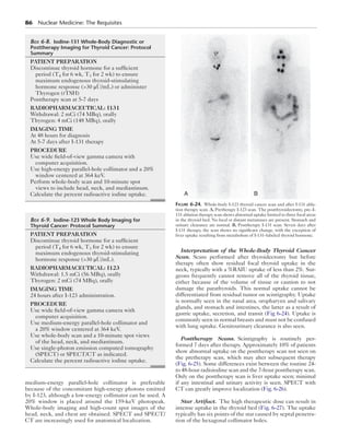 86  Nuclear Medicine: The Requisites
medium-energy parallel-hole collimator is preferable
because of the concomitant high-energy photons emitted
by I-123, although a low-energy collimator can be used. A
20% window is placed around the 159-keV photopeak.
Whole-body imaging and high-count spot images of the
head, neck, and chest are obtained. SPECT and SPECT/
CT are increasingly used for anatomical localization.
Interpretation of the Whole-Body Thyroid Cancer
Scan.  Scans performed after thyroidectomy but before
therapy often show residual focal thyroid uptake in the
neck, typically with a %RAIU uptake of less than 2%. Sur-
geons frequently cannot remove all of the thyroid tissue,
either because of the volume of tissue or caution to not
damage the parathyroids. This normal uptake cannot be
differentiated from residual tumor on scintigraphy. Uptake
is normally seen in the nasal area, oropharynx and salivary
glands, and stomach and intestines, the latter as a result of
gastric uptake, secretion, and transit (Fig 6-24). Uptake is
commonly seen in normal breasts and must not be confused
with lung uptake. Genitourinary clearance is also seen.
Posttherapy Scans.  Scintigraphy is routinely per-
formed 7 days after therapy. Approximately 10% of patients
show abnormal uptake on the posttherapy scan not seen on
the pretherapy scan, which may alter subsequent therapy
(Fig. 6-25). Some differences exist between the routine 24-
to 48-hour radioiodine scan and the 7-hour posttherapy scan.
Only on the posttherapy scan is liver uptake seen; minimal
if any intestinal and urinary activity is seen. SPECT with
CT can greatly improve localization (Fig. 6-26).
Star Artifact.  The high therapeutic dose can result in
intense uptake in the thyroid bed (Fig. 6-27). The uptake
typically has six points of the star caused by septal penetra-
tion of the hexagonal collimator holes.
	Box 6-8.  Iodine-131 Whole-Body Diagnostic or
Posttherapy Imaging for Thyroid Cancer: Protocol
Summary
PATIENT PREPARATION
Discontinue thyroid hormone for a sufficient
period (T4 for 6 wk, T3 for 2 wk) to ensure
maximum endogenous thyroid-stimulating
hormone response (30 μU/mL) or administer
Thyrogen (rTSH)
Posttherapy scan at 5-7 days
RADIOPHARMACEUTICAL: I131
Withdrawal: 2 mCi (74 MBq), orally
Thyrogen: 4 mCi (148 MBq), orally
IMAGING TIME
At 48 hours for diagnosis
At 5-7 days after I-131 therapy
PROCEDURE
Use wide field-of-view gamma camera with
computer acquisition.
Use high-energy parallel-hole collimator and a 20%
window centered at 364 keV.
Perform whole-body scan and 10-minute spot
views to include head, neck, and mediastinum.
Calculate the percent radioactive iodine uptake.
	Box 6-9.  Iodine-123 Whole Body Imaging for
Thyroid Cancer: Protocol Summary
PATIENT PREPARATION
Discontinue thyroid hormone for a sufficient
period (T4 for 6 wk, T3 for 2 wk) to ensure
maximum endogenous thyroid-stimulating
hormone response (30 μU/mL).
RADIOPHARMACEUTICAL: I123
Withdrawal: 1.5 mCi (56 MBq), orally
Thyrogen: 2 mCi (74 MBq), orally
IMAGING TIME
24 hours after I-123 administration.
PROCEDURE
Use wide field-of-view gamma camera with
computer acquisition.
Use medium-energy parallel-hole collimator and
a 20% window centered at 364 keV.
Use whole-body scan and a 10-minute spot views
of the head, neck, and mediastinum.
Use single-photon emission computed tomography
(SPECT) or SPECT/CT as indicated.
Calculate the percent radioactive iodine uptake.
A B
Figure 6-24.  Whole-body I-123 thyroid cancer scan and after I-131 abla-
tion therapy scan. A, Pretherapy I-123 scan. The postthyroidectomy, pre–I-
131 ablation therapy scan shows abnormal uptake limited to three focal areas
in the thyroid bed. No local or distant metastases are present. Stomach and
urinary clearance are normal. B, Posttherapy I-131 scan. Seven days after
I-131 therapy, the scan shows no significant change, with the exception of
liver uptake resulting from metabolism of I-131–labeled thyroid hormone.
 