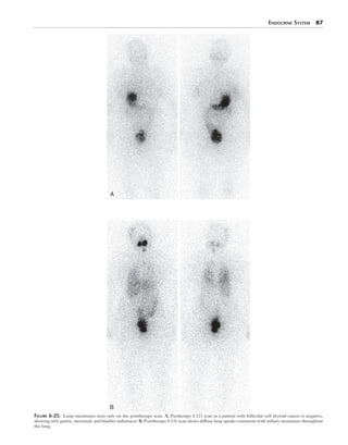 Endocrine System  87
A
B
Figure 6-25.  Lung metastases seen only on the posttherapy scan. A, Pretherapy I-123 scan in a patient with follicular cell thyroid cancer is negative,
showing only gastric, intestinal, and bladder radiotracer. B, Posttherapy I-131 scan shows diffuse lung uptake consistent with miliary metastases throughout
the lung.
 