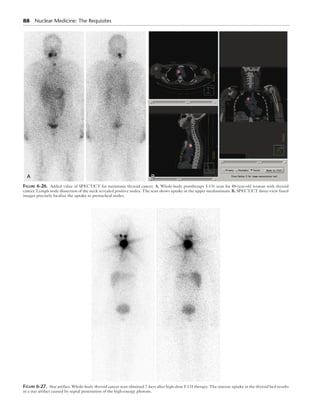88  Nuclear Medicine: The Requisites
A BB
Figure 6-26.  Added value of SPECT/CT for metastatic thyroid cancer. A, Whole-body posttherapy I-131 scan for 48-year-old woman with thyroid
cancer. Lymph node dissection of the neck revealed positive nodes. The scan shows uptake in the upper mediastinum. B, SPECT/CT three-view fused
images precisely localize the uptake to pretracheal nodes.
Figure 6-27.  Star artifact. Whole-body thyroid cancer scan obtained 7 days after high-dose I-131 therapy. The intense uptake in the thyroid bed results
in a star artifact caused by septal penetration of the high-energy photons.
 