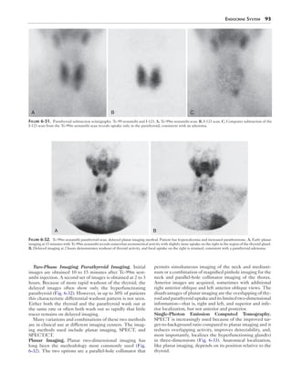 Endocrine System  93
Two-Phase Imaging Parathyroid Imaging.  Initial
images are obtained 10 to 15 minutes after Tc-99m sest-
ambi injection. A second set of images is obtained at 2 to 3
hours. Because of more rapid washout of the thyroid, the
delayed images often show only the hyperfunctioning
parathyroid (Fig. 6-32). However, in up to 30% of patients
this characteristic differential washout pattern is not seen.
Either both the thyroid and the parathyroid wash out at
the same rate or often both wash out so rapidly that little
tracer remains on delayed imaging.
Many variations and combinations of these two methods
are in clinical use at different imaging centers. The imag-
ing methods used include planar imaging, SPECT, and
SPECT/CT.
Planar Imaging.  Planar two-dimensional imaging has
long been the methodology most commonly used (Fig.
6-32). The two options are a parallel-hole collimator that
permits simultaneous imaging of the neck and mediasti-
num or a combination of magnified pinhole imaging for the
neck and parallel-hole collimator imaging of the thorax.
Anterior images are acquired, sometimes with additional
right anterior oblique and left anterior oblique views. The
disadvantages of planar imaging are the overlapping of thy-
roidandparathyroiduptakeanditslimited­two-dimensional
information—that is, right and left, and superior and infe-
rior localization, but not anterior and posterior.
Single-Photon Emission Computed Tomography. 
SPECT is increasingly used because of the improved tar-
get-to-background ratio compared to planar imaging and it
reduces overlapping activity, improves detectability, and,
most importantly, localizes the hyperfunctioning gland(s)
in three-dimensions (Fig. 6-33). Anatomical localization,
like planar imaging, depends on its position relative to the
thyroid.
A B C
Figure 6-31.  Parathyroid subtraction scintigraphy. Tc-99 sestamibi and I-123. A, Tc-99m sestamibi scan. B, I-123 scan. C, Computer subtraction of the
I-123 scan from the Tc-99m sestamibi scan reveals uptake only in the parathyroid, consistent with an adenoma.
A B
Figure 6-32.  Tc-99m sestamibi parathyroid scan, delayed planar imaging method. Patient has hypercalcemia and increased parathormone. A, Early planar
imaging at 15 minutes with Tc-99m sestamibi reveals somewhat asymmetrical activity with slightly more uptake on the right in the region of the thyroid gland.
B, Delayed imaging at 2 hours demonstrates washout of thyroid activity, and focal uptake on the right is retained, consistent with a parathyroid adenoma.
 